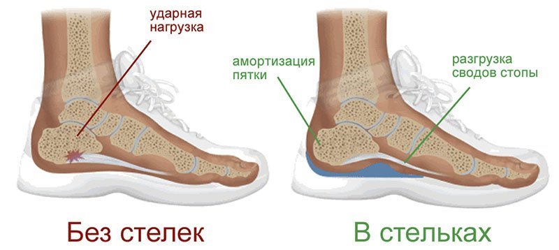 Ортопедические стельки польза Ортопедические стельки польза