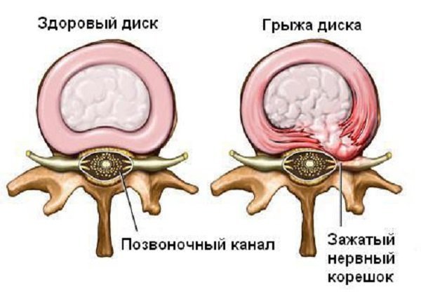Грыжа4_600_419.jpg Грыжа4_600_419.jpg